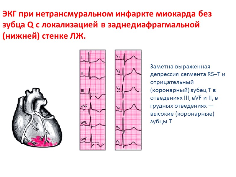 Заметна выраженная депрессия сегмента RS–Т и отрицательный (коронарный) зубец Т в отведениях III, аVF